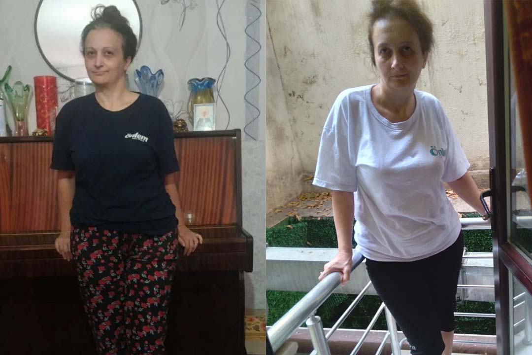 diana-gazarova-after Диана Газарова после первого этапа лечения стволовыми клетками